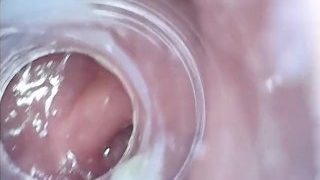 マイクロカメラでアナル内部撮影。直腸からＳ字まで。